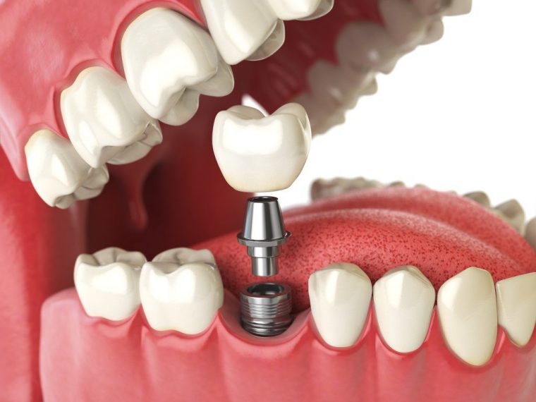 trồng 4 răng cửa bằng trồng răng implant