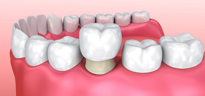 trồng răng khi không còn chân răng